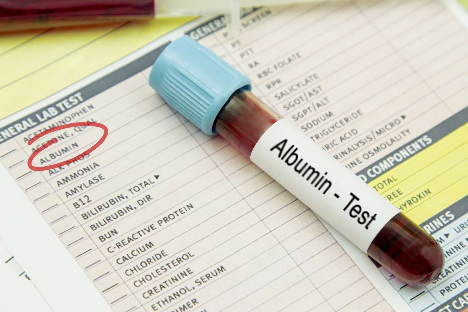 ALBUMIN - SERUM