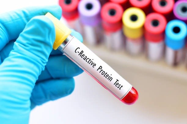 C-REACTIVE PROTEIN (CRP)