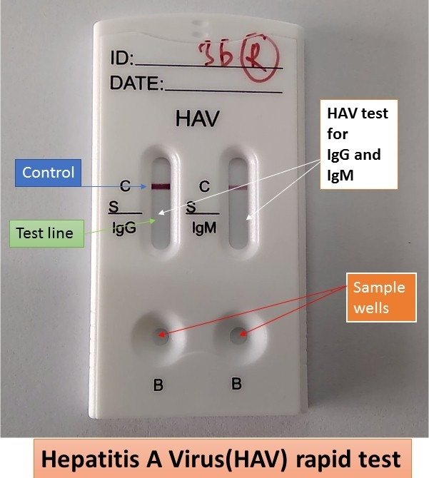 HEPATITIS A VIRUS ANTIBODY IGM(HAVM) RAPID TEST