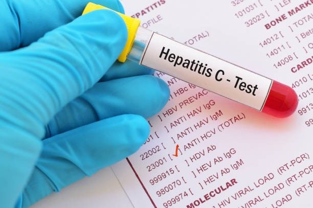 HEPATITIS C VIRUS - IGM