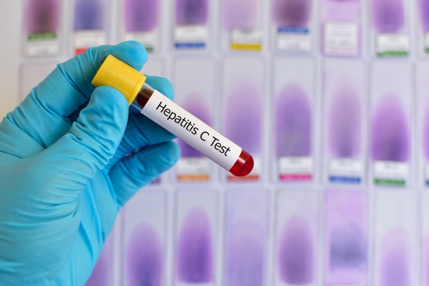 HEPATITIS C VIRUS (HCV) QUALITATIVE PCR