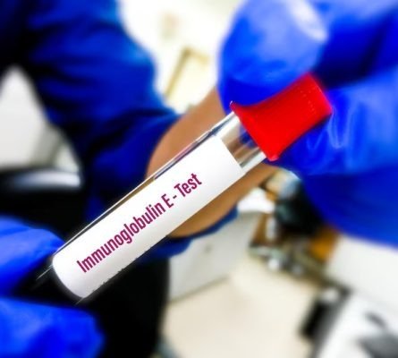 IMMUNOGLOBULIN E (IGE)