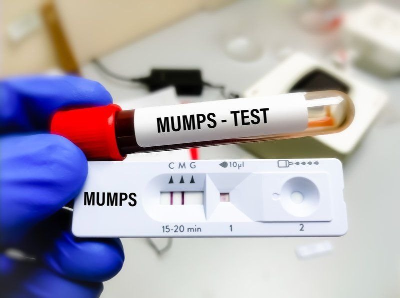 MUMPS ANTIBODY - IGM
